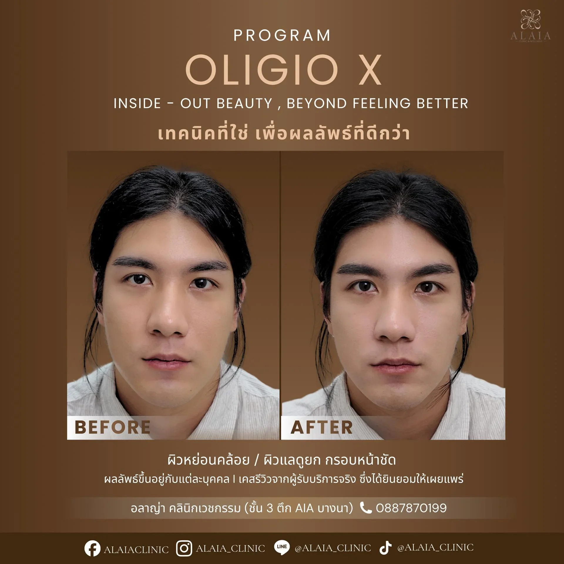 Program Oligio X Review